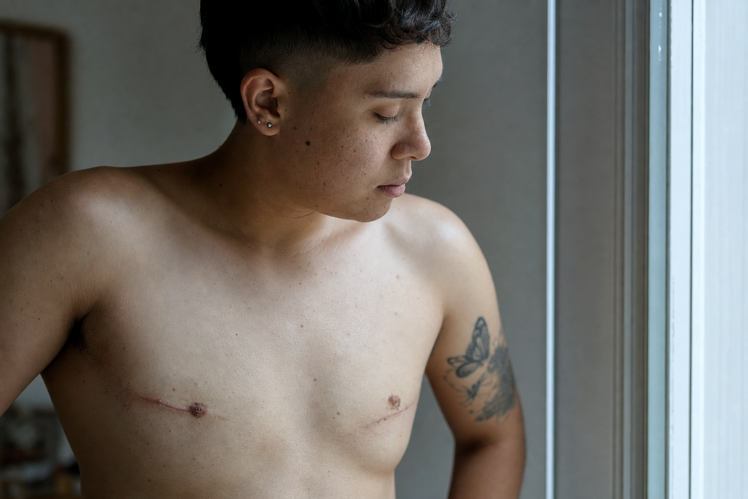 Key Benefits of ftm top surgery techniques — illustrating ftm top surgery techniques